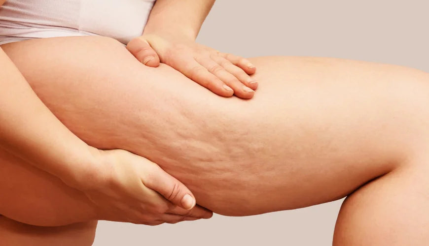 Cellulite sur les cuisses