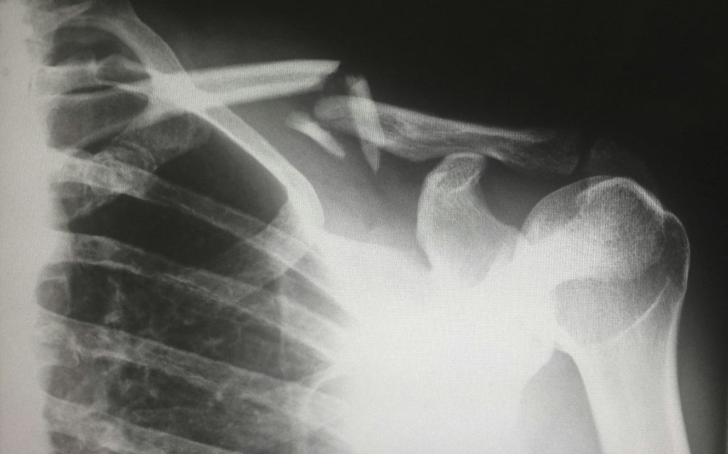 Diet and lifestyle tips for osteopenia and osteoporosis